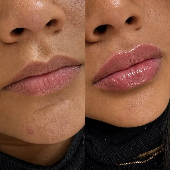 Antes e depois de preenchimento labial com ácido hialurônico realizado pela Dra. Bárbara